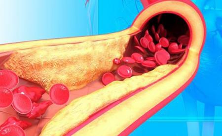 4 triệu chứng trên bàn chân cảnh báo mỡ máu cao